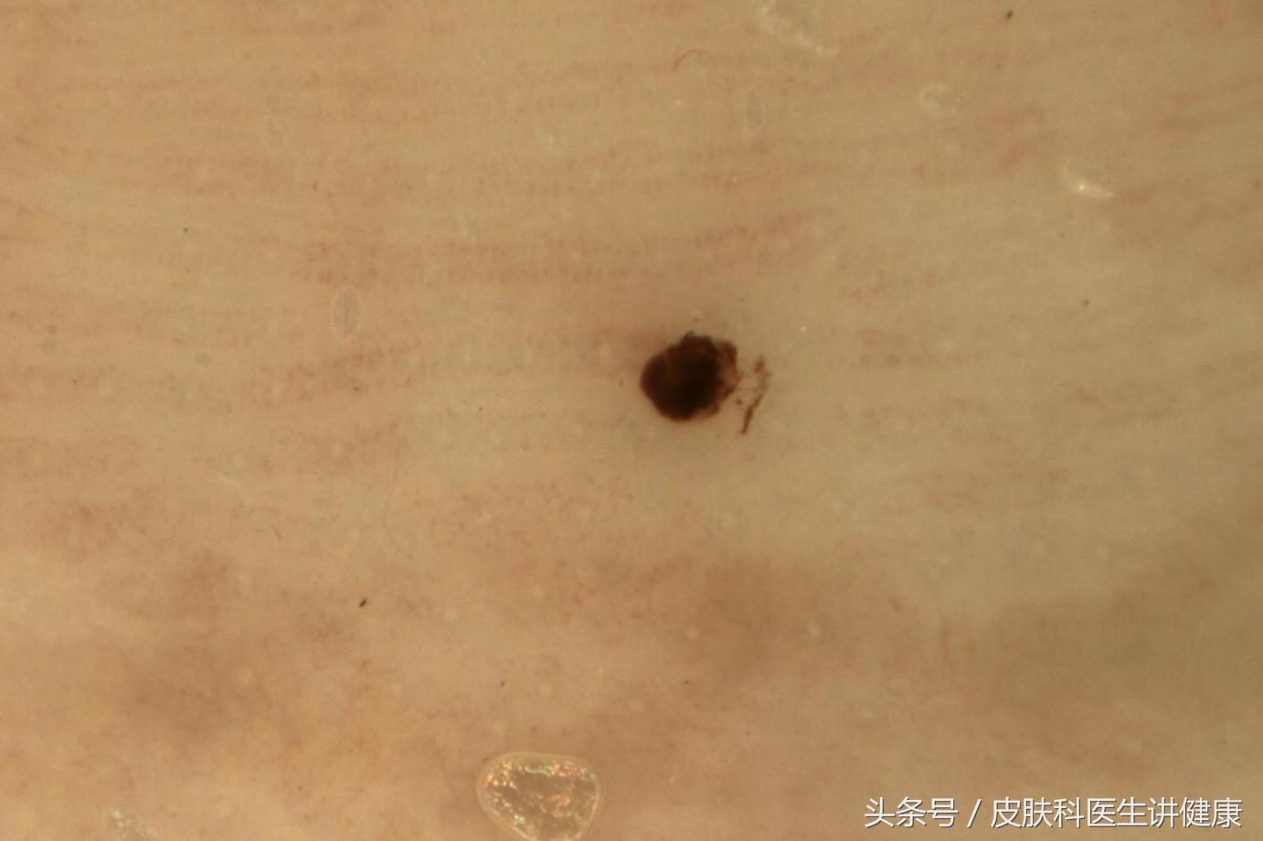 色素痣会出现大面积皮肤发黑吗,如何区分黑斑与色素痣