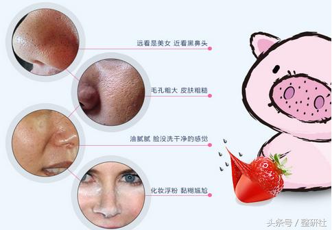 医美去黑头小妙招,医美去黑头有多少种方法