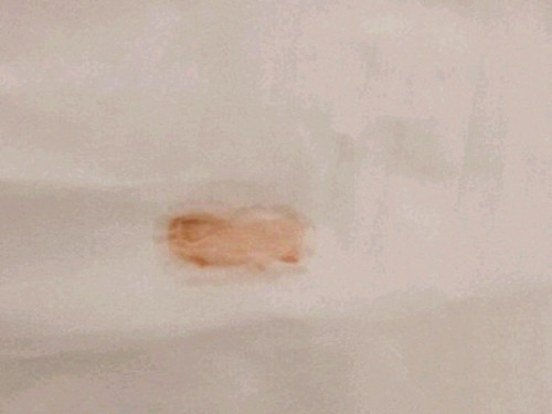 产后上大厕出血怎么办,产妇上厕所大便有血如何处理