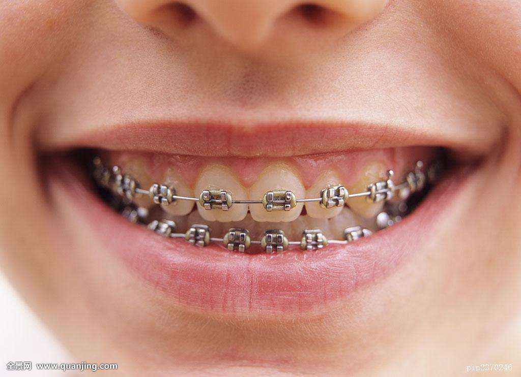 不用牙套能不能把龅牙搞回去,少了一颗牙齿戴牙套矫正全过程