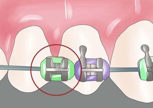 不用牙套能不能把龅牙搞回去,少了一颗牙齿戴牙套矫正全过程