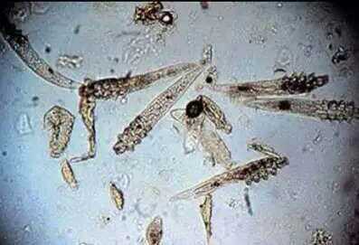 脸上毛孔里挤出白色条状是螨虫吗,脸上长螨虫的表现你中招了吗