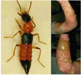 幼儿被蜱虫叮咬多长时间发病,孩子被蜱虫叮咬痛骂