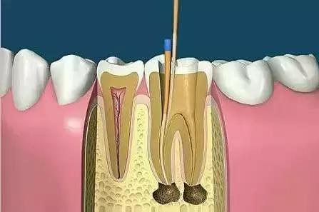 根管治疗牙套贵和便宜的区别,根管治疗后嵌体修复贵还是牙冠贵
