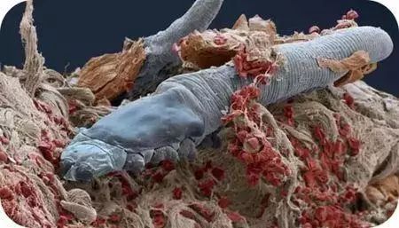 脸上的螨虫和被子里的螨虫,脸上的螨虫和被子上的螨虫一样吗