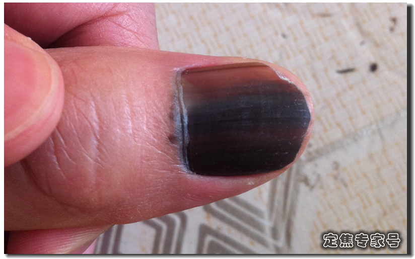 黑痣也算痣吗,怎么判断天生黑痣是好的坏的