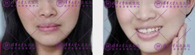 不复发黄褐斑怎么治疗,褐斑用什么治最好