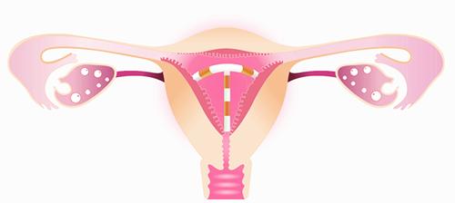 节育环戴时间长了会长进肉里去吗,节育环如果长到肉里会有什么反应