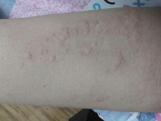 一个彻底根除荨麻疹的土方法,超详细的荨麻疹治疗方案