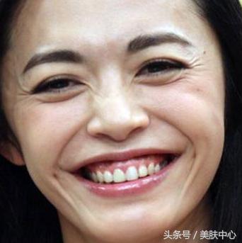 25岁比同龄人还老法令纹很深,20岁法令纹很深是什么原因