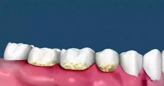 牙齿矫正出现黑三角,儿童牙齿矫正会出现黑三角吗