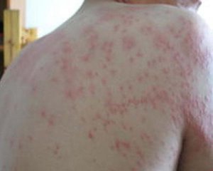 一个彻底根除荨麻疹的土方法,超详细的荨麻疹治疗方案