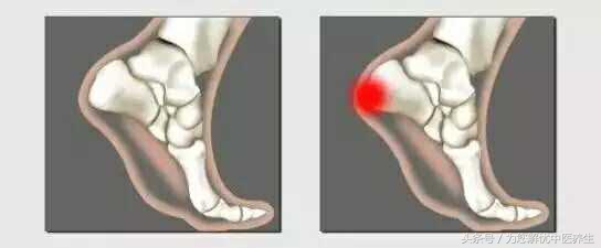足跟痛如何用药,足跟痛治疗方法及用药
