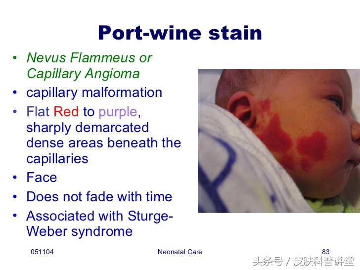 治疗鲜红斑痣胎记最好的医院,鲜红斑痣好治还是红胎记好治