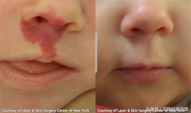 治疗鲜红斑痣胎记最好的医院,鲜红斑痣好治还是红胎记好治