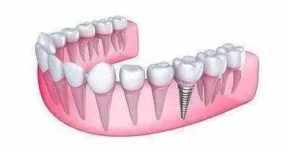 智齿导致旁边牙齿龋齿,智齿有龋齿有必要修补吗