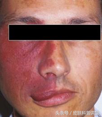 治疗鲜红斑痣胎记最好的医院,鲜红斑痣好治还是红胎记好治