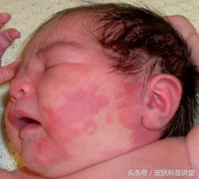 治疗鲜红斑痣胎记最好的医院,鲜红斑痣好治还是红胎记好治