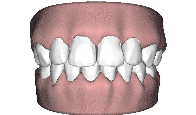 隐形牙套和钢牙套各有什么优缺点,儿童整牙是隐形牙套好还是钢牙好