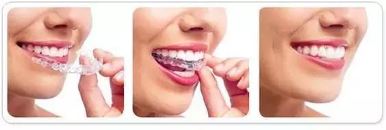 隐形牙套和钢牙套各有什么优缺点,儿童整牙是隐形牙套好还是钢牙好