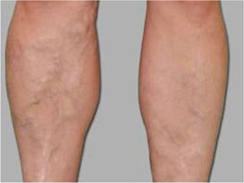 下肢静脉曲张的症状及治疗方法,下肢静脉轻度曲张穿几级弹力袜