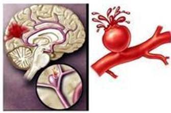 可怕定时炸弹颅内动脉瘤,颅内不定时炸弹动脉瘤