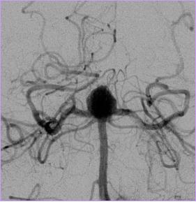 可怕定时炸弹颅内动脉瘤,颅内不定时炸弹动脉瘤