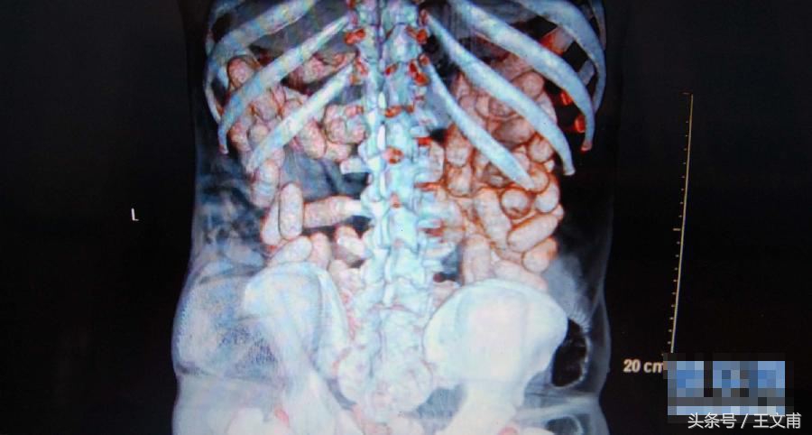 比好莱坞大片还震撼！带你识别人体藏毒的凶残手法