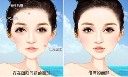 脂肪移植术后需要注意什么,自体脂肪移植填充泪沟多久恢复