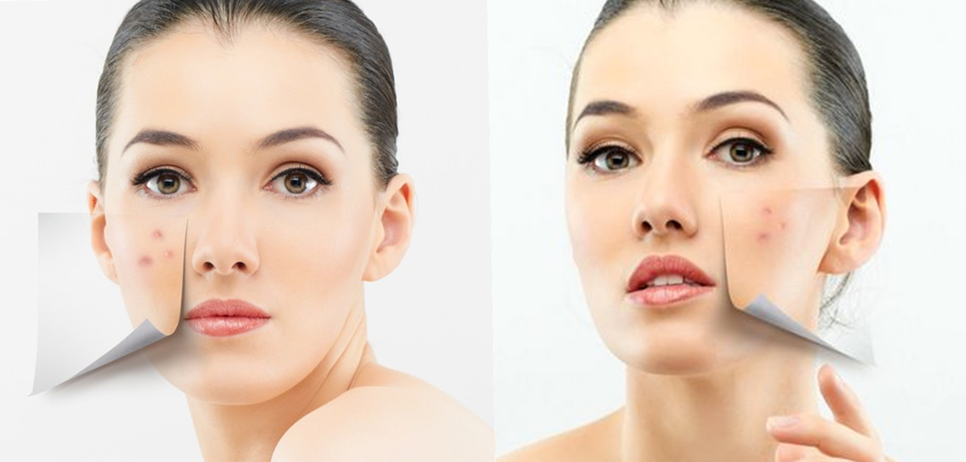 痘痘真的不能挤也不要涂药,痘痘真的无药可救吗