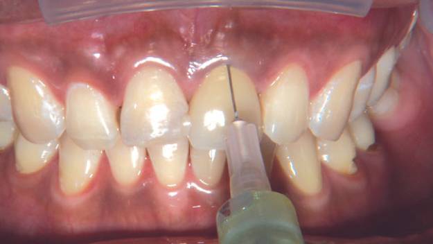 牙医如何快速知道你哪颗牙齿痛,牙齿痛小常识