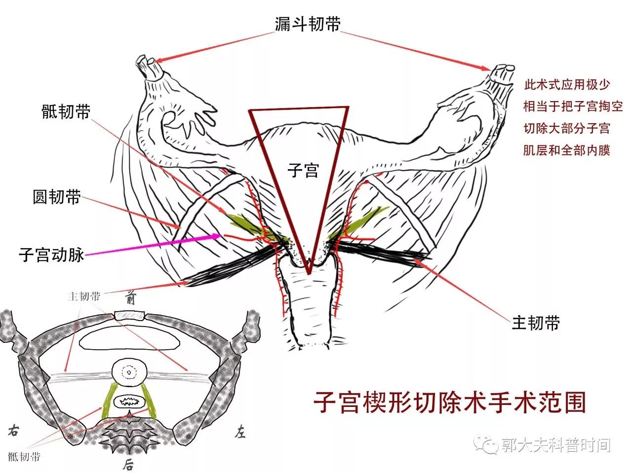 关于子宫切除的小秘密（一）——切除范围