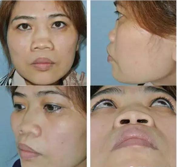 一张图让你全面了解鼻综合整形,鼻综合整形后鼻子一般多久消肿