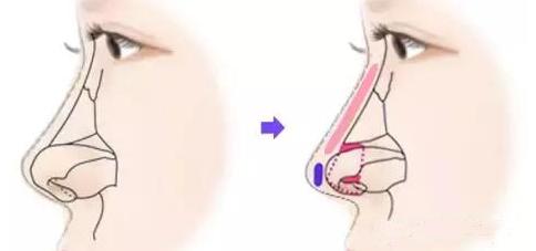 一张图让你全面了解鼻综合整形,鼻综合整形后鼻子一般多久消肿