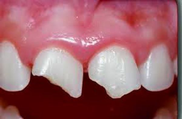 牙医如何快速知道你哪颗牙齿痛,牙齿痛小常识