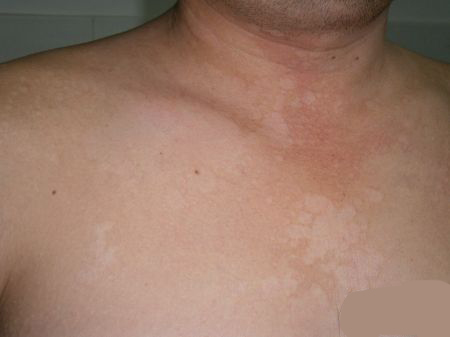 一个不能忽略的感染，皮肤真菌感染的药物治疗