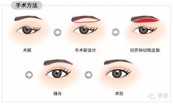 抬头纹手术会不会影响眼睛,抬头纹手术后有后遗症吗