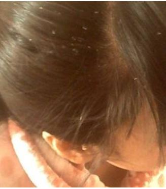 头皮屑满天飞吃什么能缓解,头皮屑像雪花满天飞