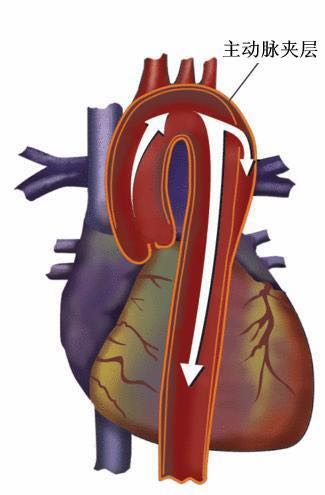 心血管主动脉夹层症状,心血管爆裂是主动脉夹层吗