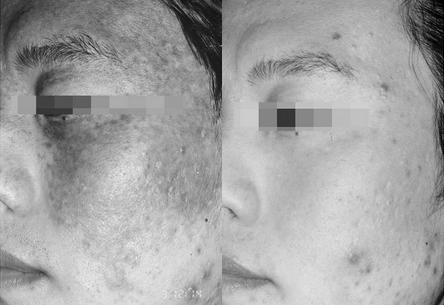 脸上长老年斑怎么办小妙招,黑斑又叫面尘斑怎么去除