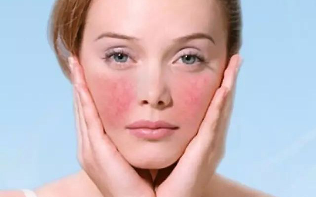 脸颊红血丝改善小窍门,怎么样淡化脸颊两边的红血丝