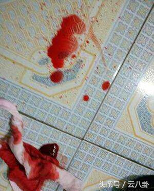 怀孕初期腿上青筋会跳明显吗,生完小孩小腿有条黑线是怎么回事