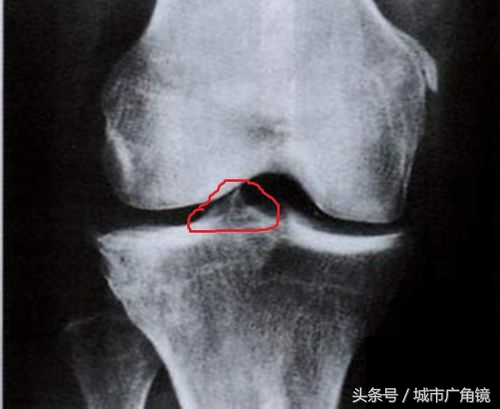 医院开的外敷药能治疗骨刺吗,膏药能彻底根治骨刺