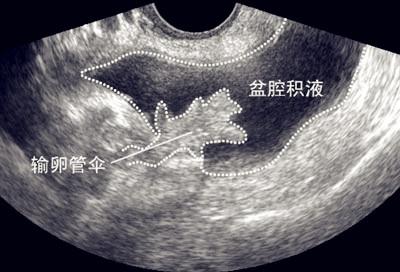 按一下肚子会发出水声？逃离不了这6种情况，病理性积水需谨慎