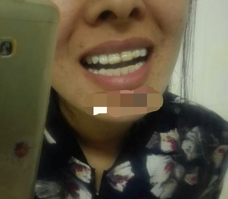 比较有效的牙齿美白方法,你需要知道的牙齿美白小窍门