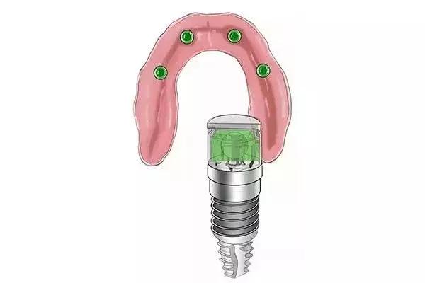 缺牙是种植牙还是烤瓷牙好,烤瓷牙和种植牙哪个保持时间长