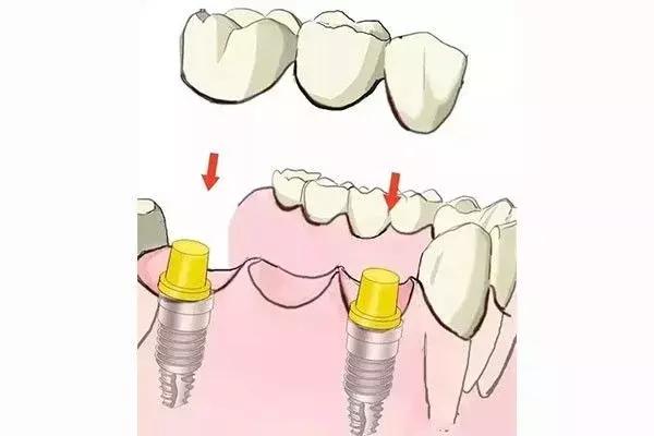 缺牙是种植牙还是烤瓷牙好,烤瓷牙和种植牙哪个保持时间长