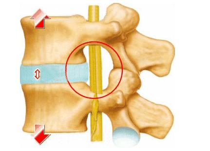 腰突什么情况就不能做微创了,腰突所谓的治愈就是症状消失吗