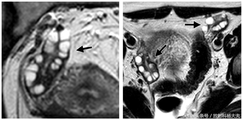 周杰伦昆凌有多囊卵巢综合征,昆凌被周杰伦宠爱的秘诀