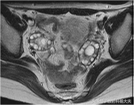 周杰伦昆凌有多囊卵巢综合征,昆凌被周杰伦宠爱的秘诀